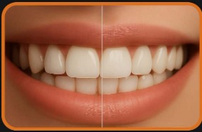 Hollywood Smile